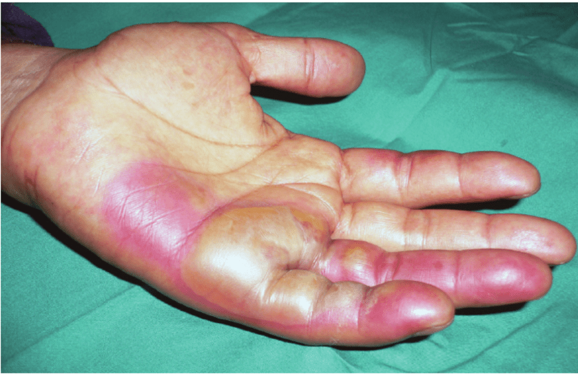 Burns-to-left-hand-after-exposure-to-radiation-source