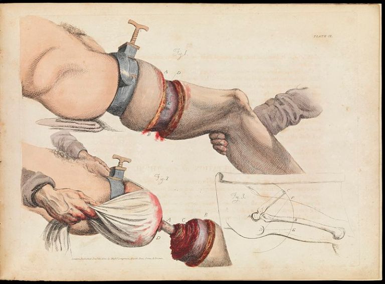 Plate_IX_illustration_of_leg_amputation_Sir_Charles_Bell_Wellcome_L0072192.jpg